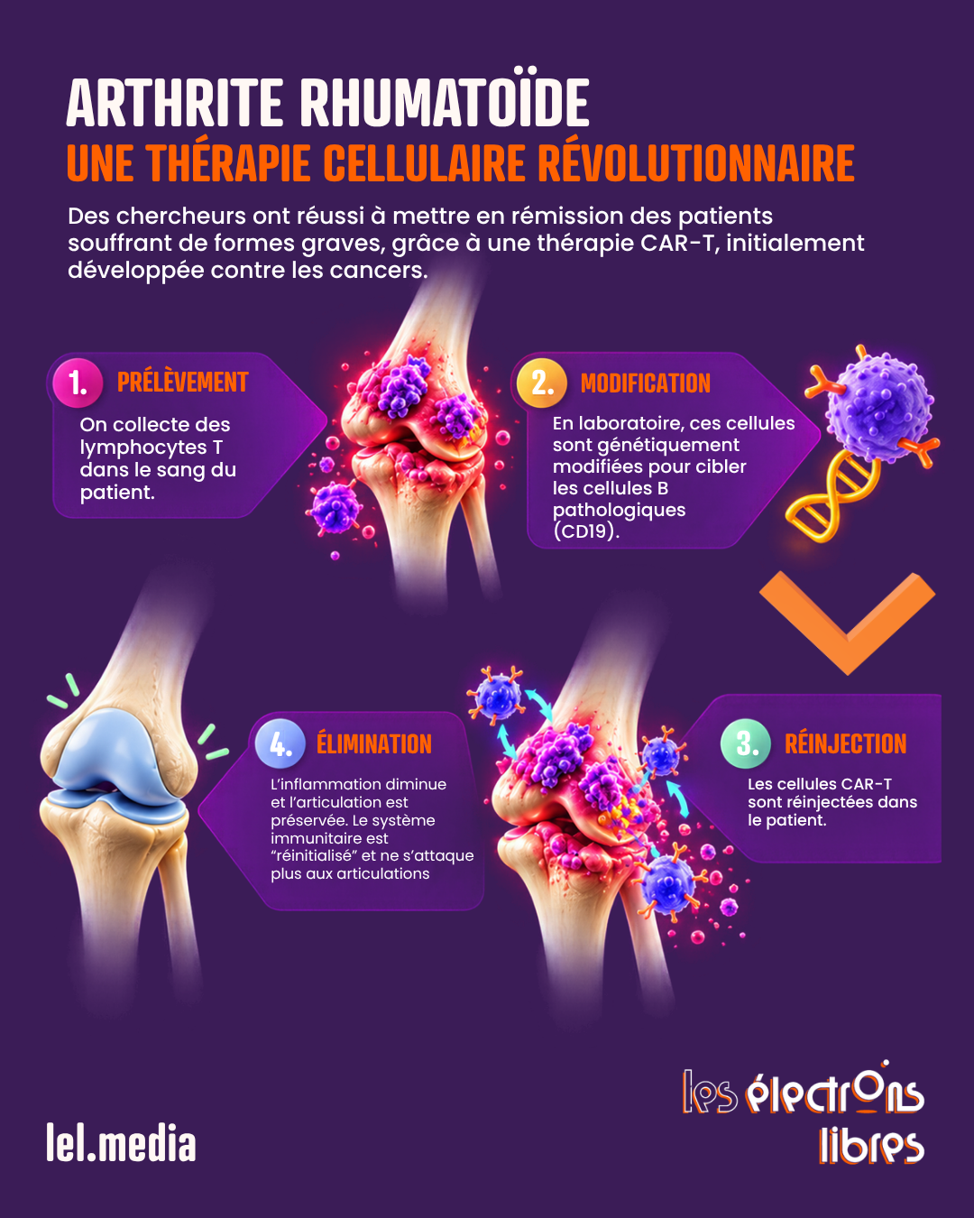 Infographie expliquant le fonctionnement de la thérapie par cellules CAR-T pour traiter l'arthrite rhumatoïde en quatre étapes.
